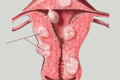 子宫肌瘤的危害有哪些