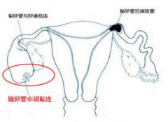 输卵管粘连对女性怀孕有影响吗
