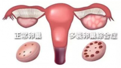 多囊卵巢综合征能治好吗
