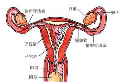 输卵管堵塞的原因有哪些